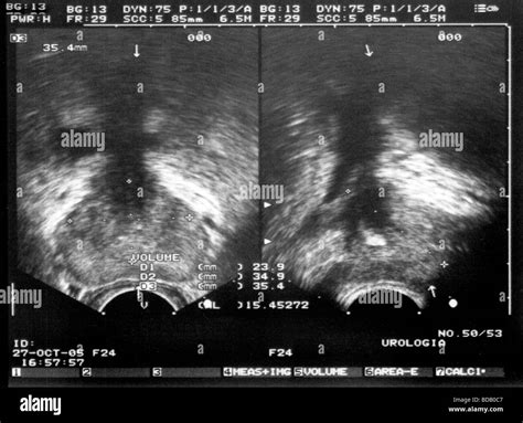 Prostate Anatomy Ultrasound