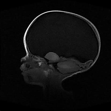 HYDRANENCEPHALY | buyxraysonline