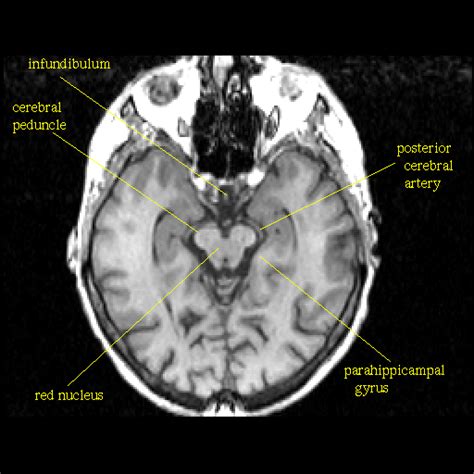 Cerebellar Peduncle Mri Anatomy