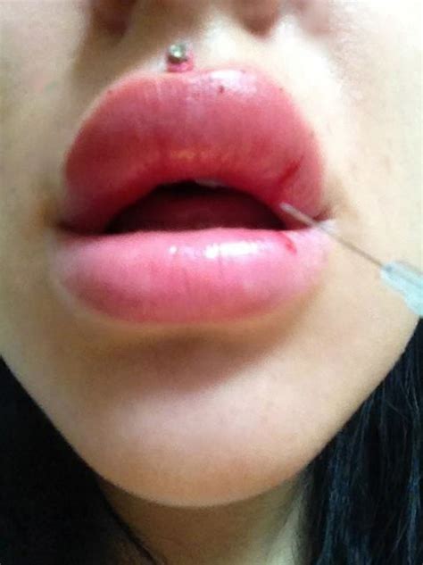 REVEALED: Lip filler frenzy leaving teenage girls with HORRIFIC damage | UK | News | Express.co.uk