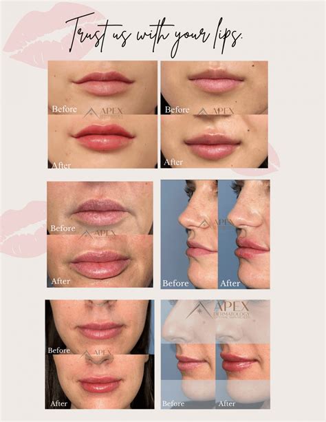 Trust Us With Your Lips: Apex Dermatology: Skin Care Specialists