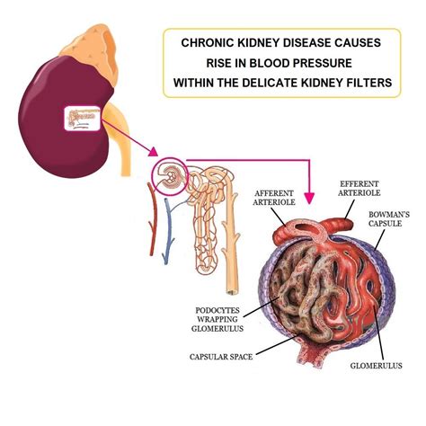 High Blood Pressure in CKD - All Things Kidney ~ Official