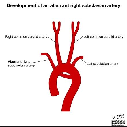 branch of subclavian artery - Captions Time