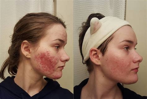 How 50 Different Redditors Cleared Their Acne Using Science!