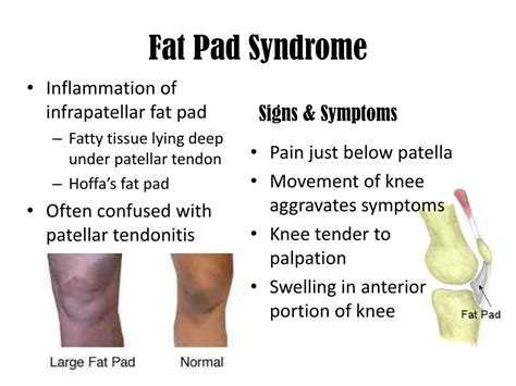 Knee Fat Pad Syndrome