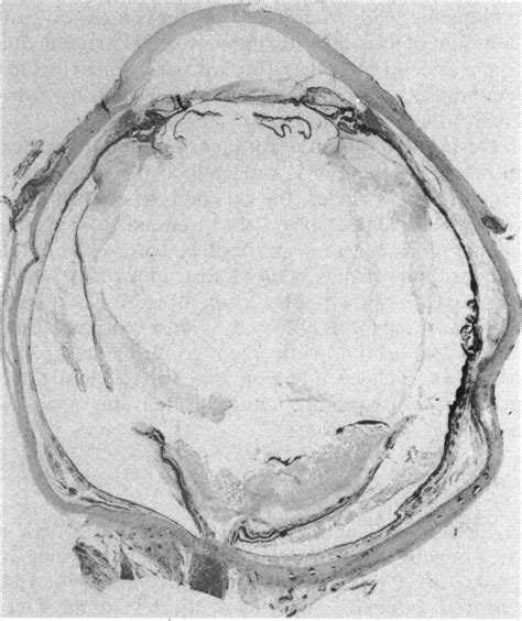 Photomicrograph ofhistological section ofthe enucleated right eye. The ...