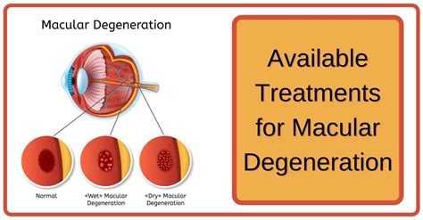 Dealing with Macular Degeneration