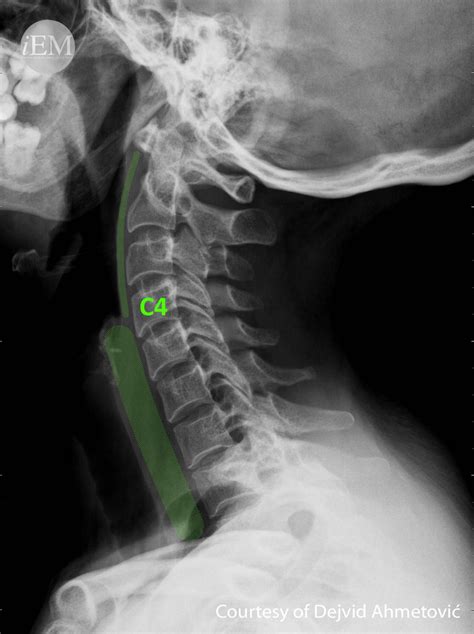 Normal Lateral Spine X Ray