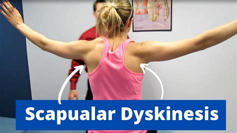 Scapular Dyskinesis Bilaterally - YouTube