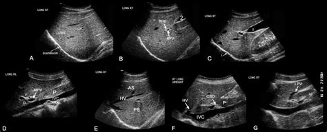 WK 2 LIVER G- LT PORTAL VEIN