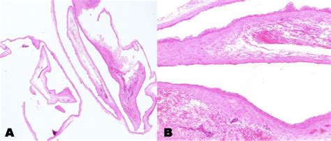 Large conjunctival epithelial inclusion cyst following scleral tunnel ...