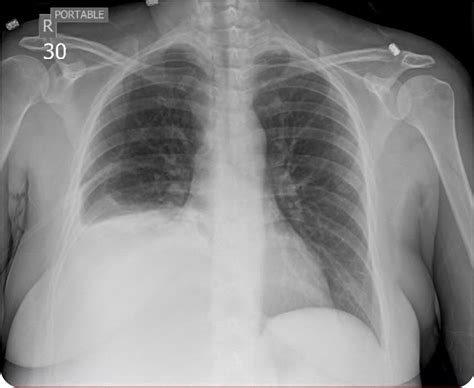 Costophrenic Angle Pleural Effusion