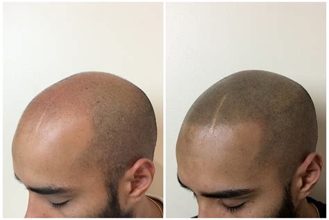 Scalp Micropigmentation Before and After Results | Elite Institute of ...