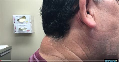 Watch Dr. Pimple Popper BLAST the Massive Zit on Man’s Neck [VIDEO] | John Hawkins' Right Wing News