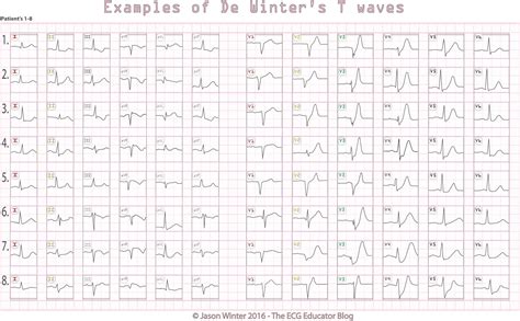 ECG Educator Blog : De Winters T waves