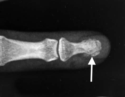 FINGER DISTAL PHALANX FRACTURES | Hand Surgery Resource