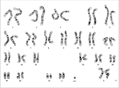 A karyotype of 47,XX,þmar. mar ¼ marker chromosome. | Download Scientific Diagram