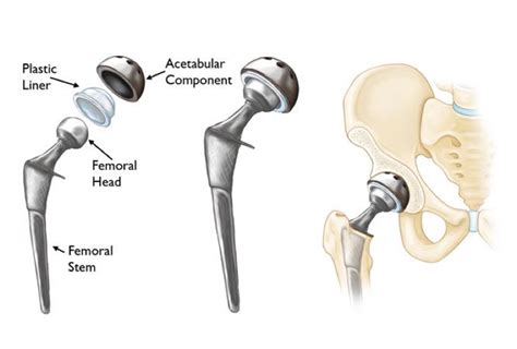 Total Hip, Anterior Hip Replacement Surgery by Dr David Slattery