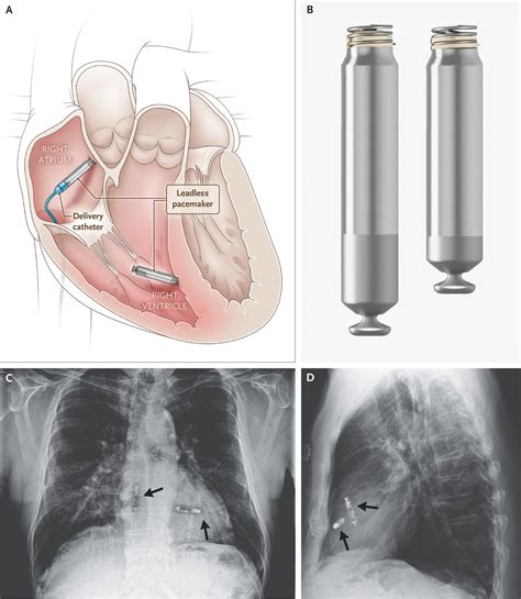 A Dual-Chamber Leadless Pacemaker | New England Journal of Medicine