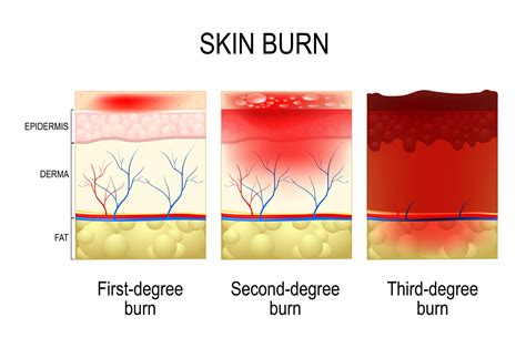 Second Degree 1St Degree Burn Pictures : Anatomical Skin Model With Normal Skin 1st 2nd And 3rd ...