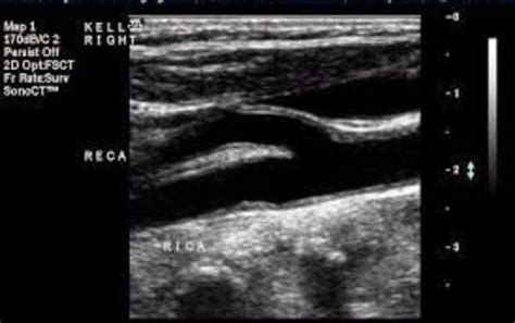 Carotid arteries, screening ultrasound. by Vital Health Scores in Traverse City, MI - Alignable