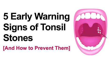 5 Early Warning Signs of Tonsil Stones (And How to Prevent Them)