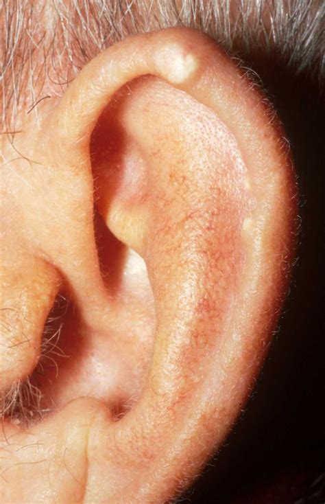 tophus ear - Buscar con Google