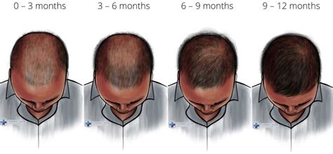 hair transplant timeline reddit - Super Colossal Biog Photo Gallery