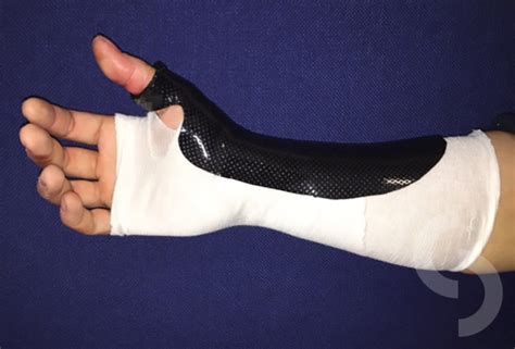 Picture 8: Custom made splint worn after thumb surgery for few weeks | dr Sonja Cerovac