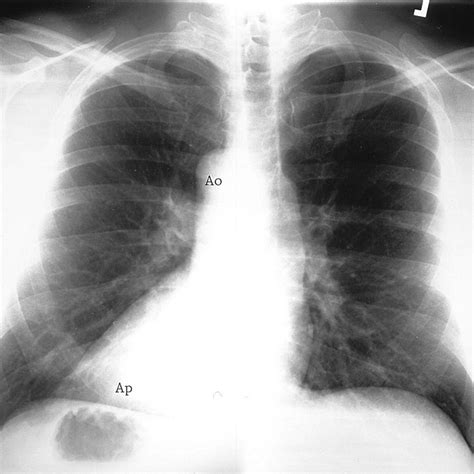 Mirror-Image Dextrocardia With Situs Inversus | Circulation