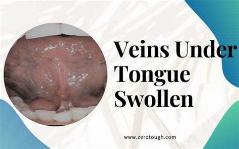 Veins Under Tongue Swollen