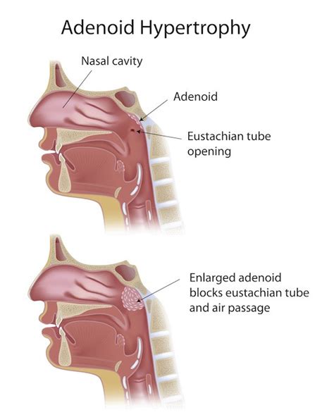 Adenoid Hypertrophy | Causes & Homeopathic Treatment