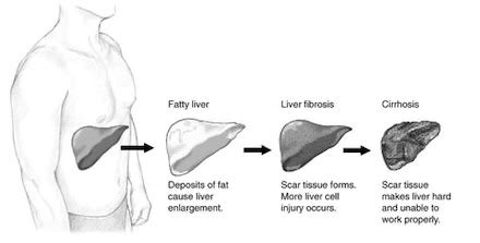 Protuberant Abdomen | Definition, Symptoms & Causes - Lesson | Study.com