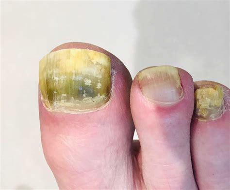 Fungal Nail - 6 Top Questions Answered - A Step Ahead Foot and Ankle Care