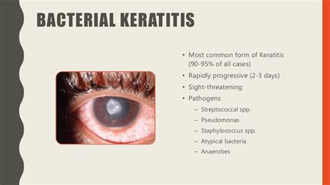 Keratitis