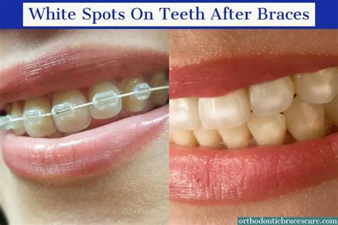 White Spots On Teeth After Braces: Causes, How To Fix - Orthodontic ...