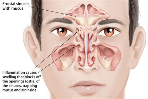 Acute and Chronic Sinusitis and Allergies