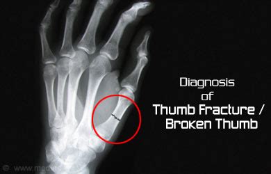 Thumb Fractures / Broken Thumb - Causes, Symptoms, Diagnosis, Treatment