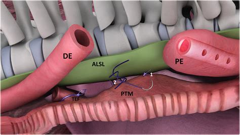 Thoracoscopic posterior tracheopexy during primary esophageal atresia repair: a new approach to ...