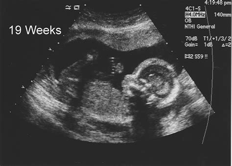 Baby Heise 19 week anatomy scan profile | 19 week ultrasound… | Flickr