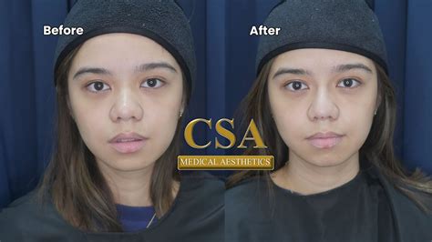 Filipino Nose Job Before And After