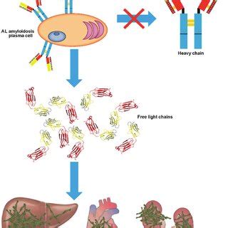 Light chain amyloidosis pathology. Clonal expansion of plasma cells ...