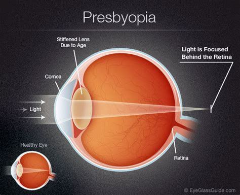 Presbyopia causes, symptoms & treatments | Assil Gaur Eye