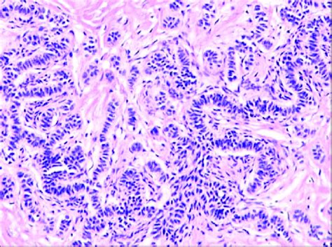 Canine RT trichoblastoma-long cords of cells with nuclei arranged in a ...