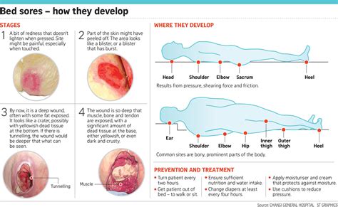 How Do You Heal Bed Sores Naturally at David Holman blog