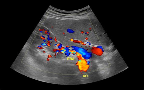 Renal Arterial Doppler Study in Cumming and Suwanee, GA | North Atlanta Vascular Clinic