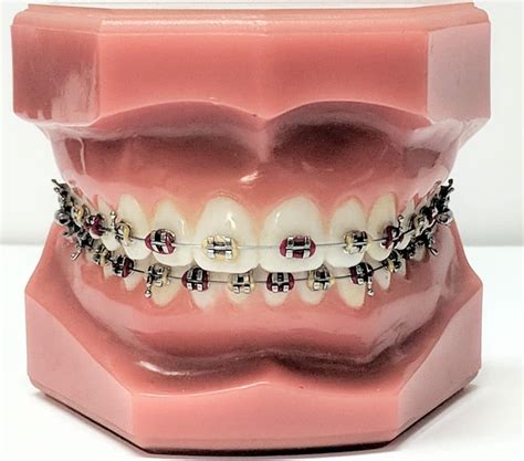 Metal, Clear and Ceramic Braces. What’s the Difference? | True Orthodontics, PC