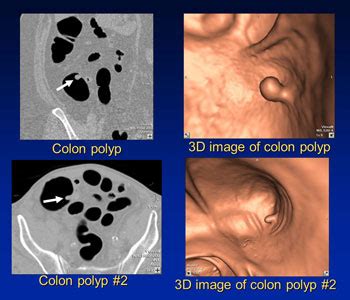 Time For Your Colonoscopy? Standard vs. Virtual Colonoscopy - Mallinckrodt Institute of ...