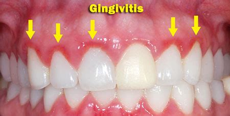 What is Gingivitis?