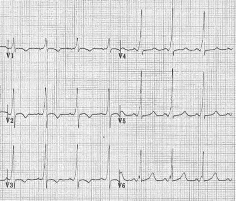 R wave • LITFL • ECG Library Basics